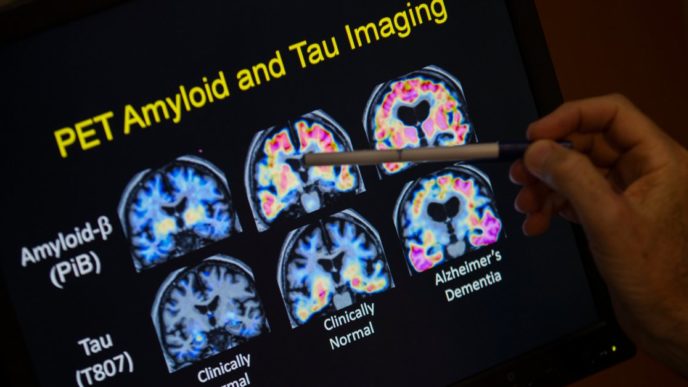 alzheimers blood test