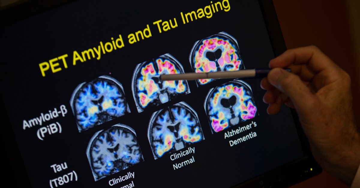 alzheimers blood test